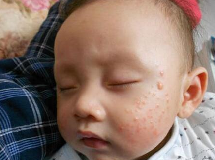 夏季宝宝老是皮肤红红痒痒的怎么办？别急那是湿疹惹的祸！