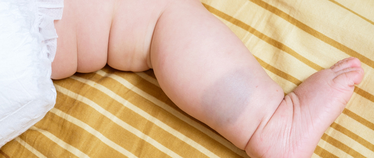 教你迅速区分宝宝胎记