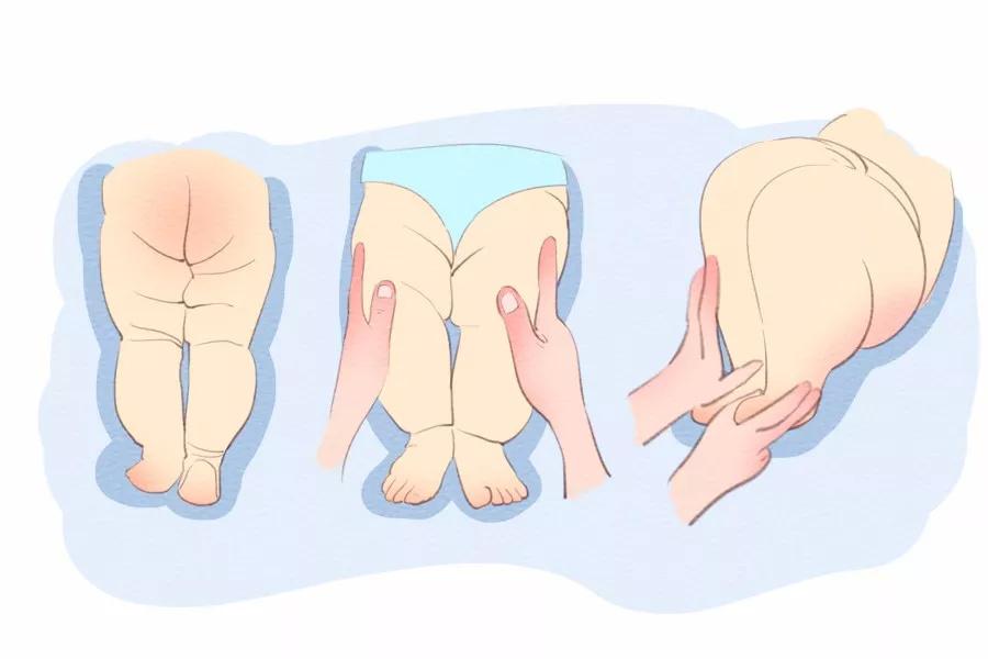 孩子腿纹不对称到底怕不怕？