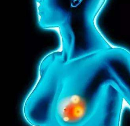 乳腺增生的4大“死对头”，每天吃一点，化瘀散结比吃药都强！