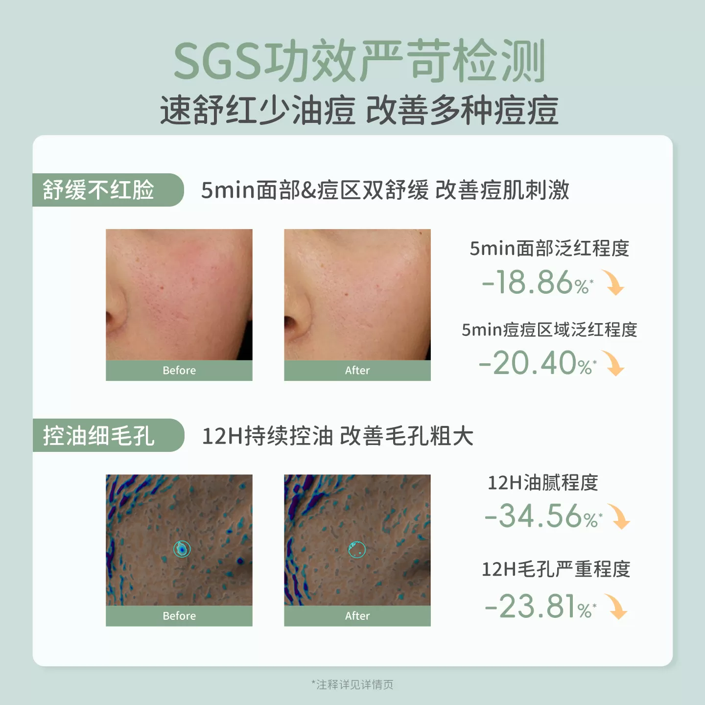 袋鼠妈妈青少年爽肤水学生控油祛痘男女孩祛痘补水平衡水油护肤水
