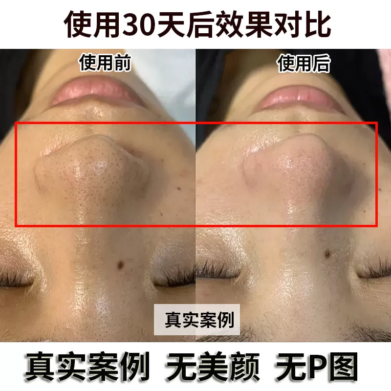韩纪茶树去黑头套盒官方正品收毛孔深层清洁院线大牌专用XZA69